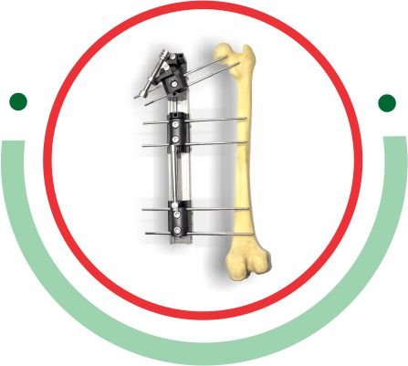 Zailfix LRS Ex-Fix System