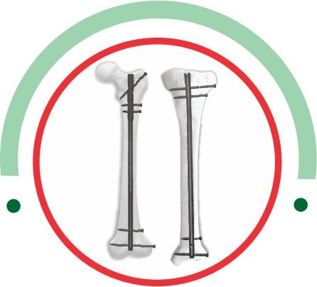 Tibia Femur Nailing System