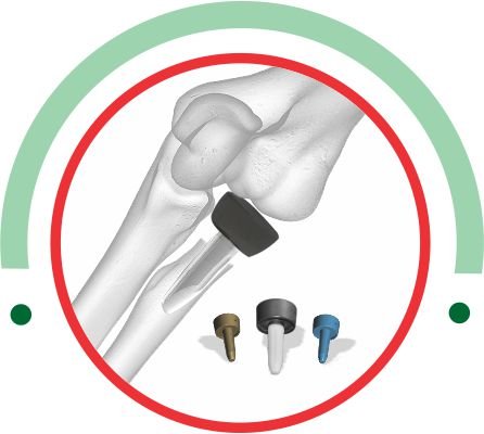 Radial Head Prosthesis