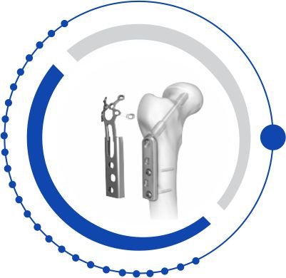DHS/DCS Implants & Instrument
