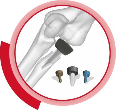 Radial Head Prosthesis