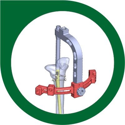 SupraPatellar Nailing System