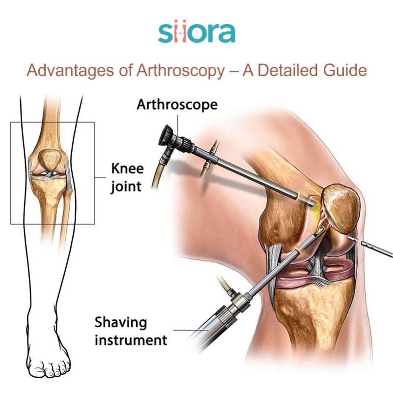 Read more about the article Advantages of Arthroscopy – A Detailed Guide