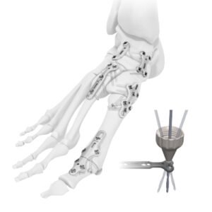 Variable Angle Forefoot & Midfoot 2.4/2.7 mm System