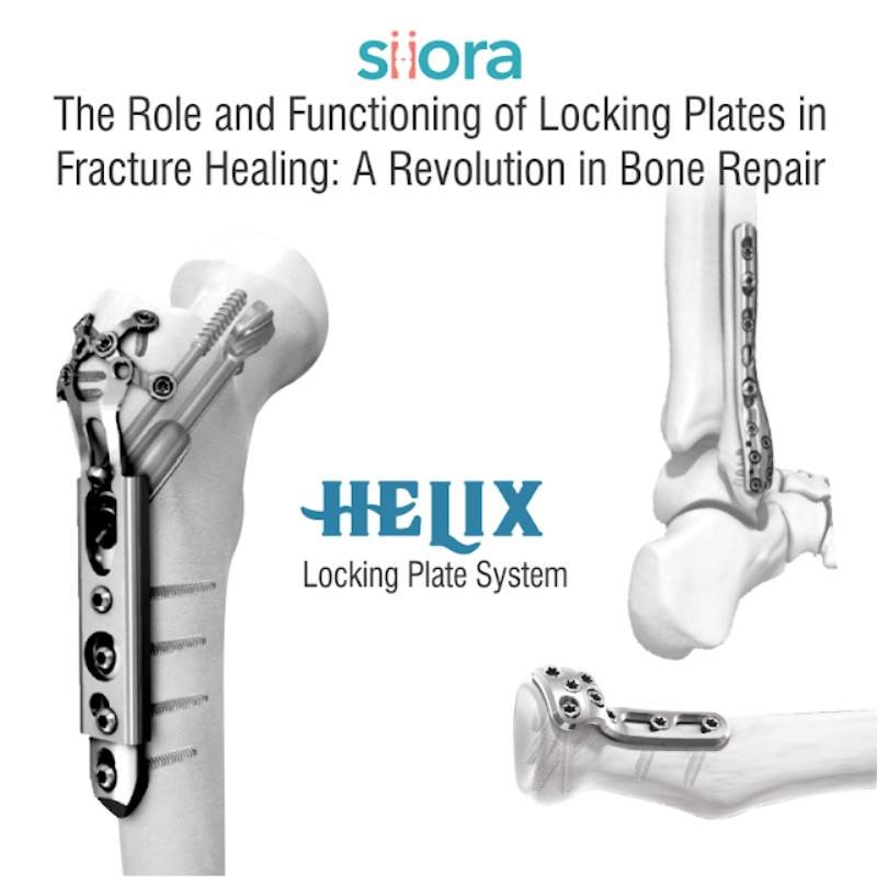 Locking Plates in Fracture Healing