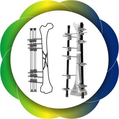 External Fixator System