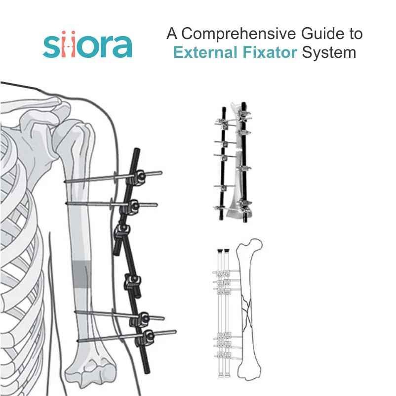 External Fixator