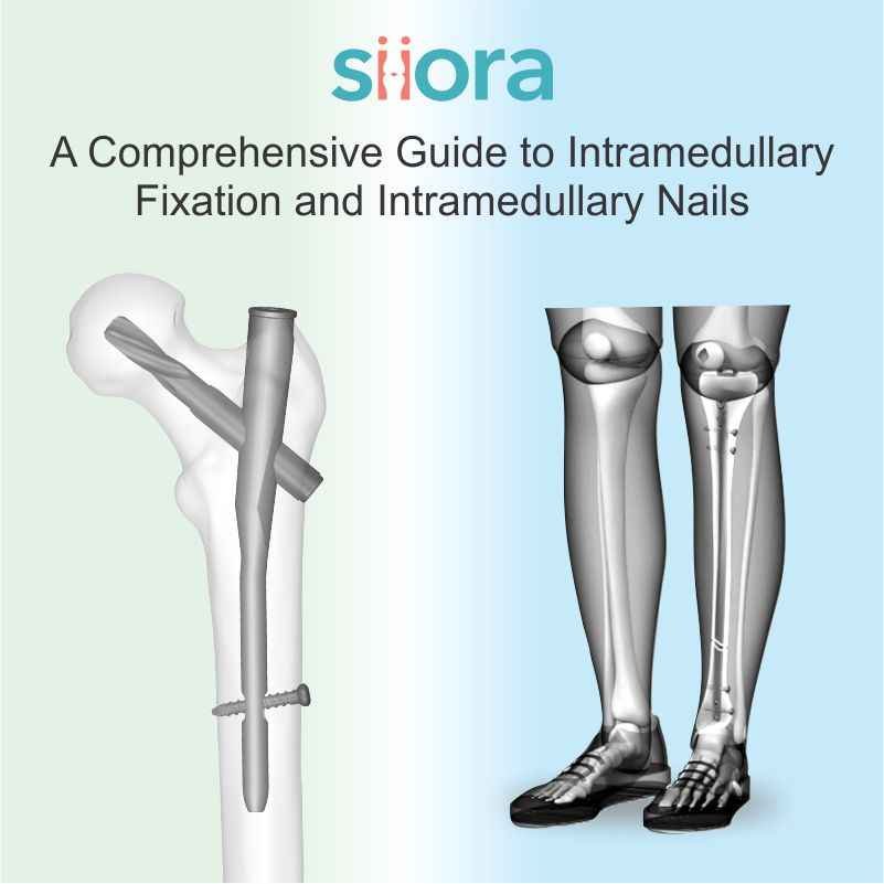 Intramedullary Nail