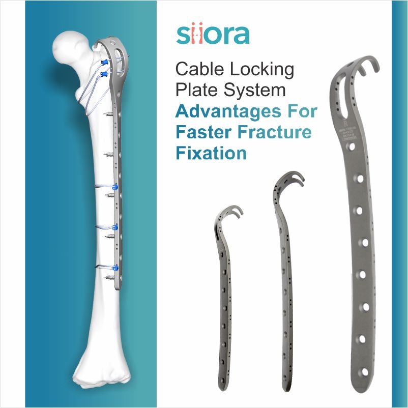 Cable Locking Plate System Advantages for Faster Fracture Fixation