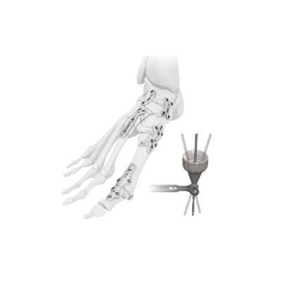Exofoot-Variable-Angle-Forefoot-Midfoot-2.42.7-mm-System