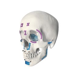 Maxillofacial Implants