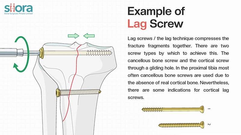 Lag Screw