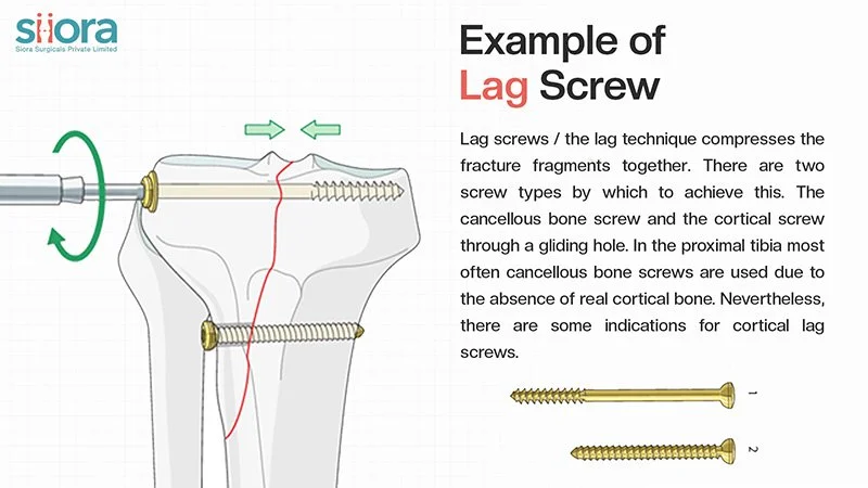 lag-screw