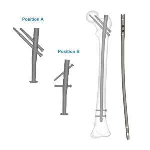 Aduera™ Expert Femur Nail – Titanium