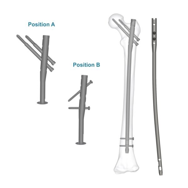 Aduera™ Expert Femur Nail – Titanium