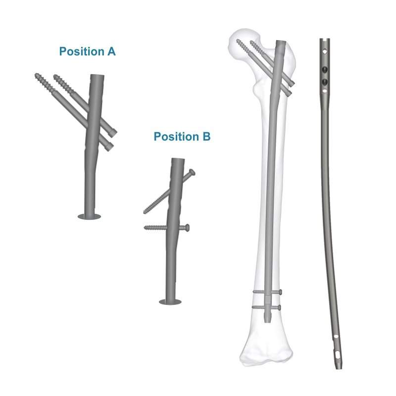 Aduera™ Expert Femur Nail – Titanium