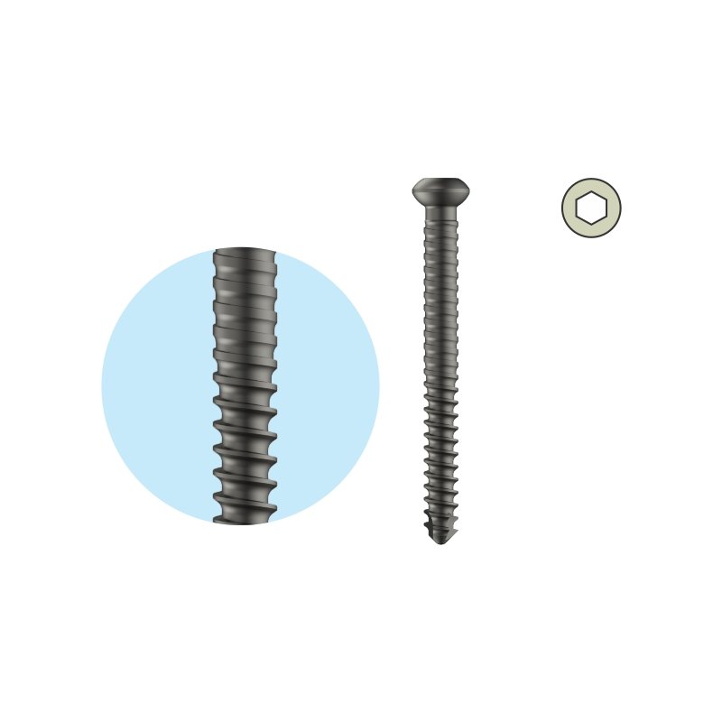 Dual Core Locking Bolt Dia. 4.7mm- Self Tapping