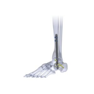 Tarsofix Ankle Nailing System