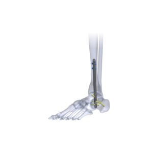 Tarsofix Ankle Nailing System