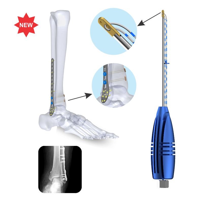 Flex Rope for Syndesmosis Repair, titanium - Sterile