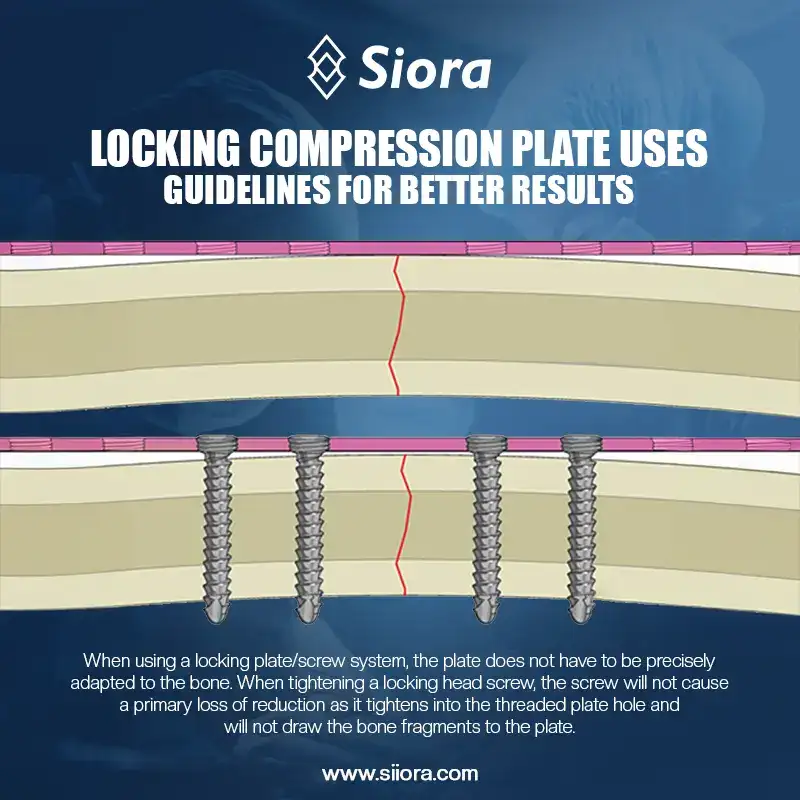 Locking Compression Plate Uses