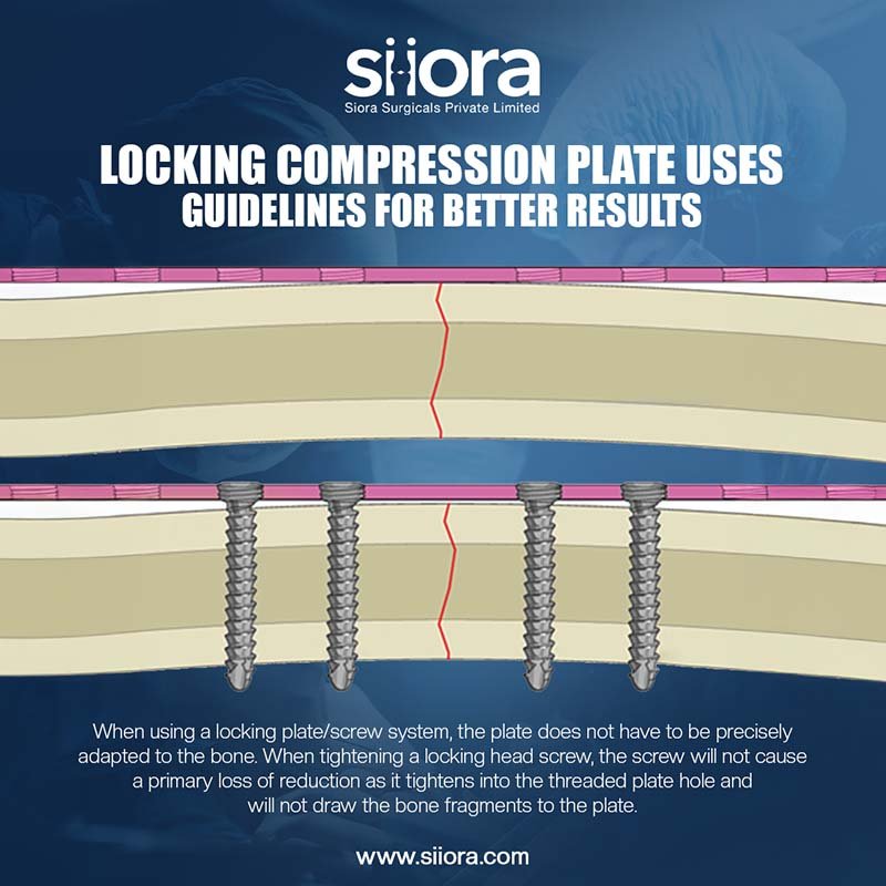 Locking Compression Plate Uses