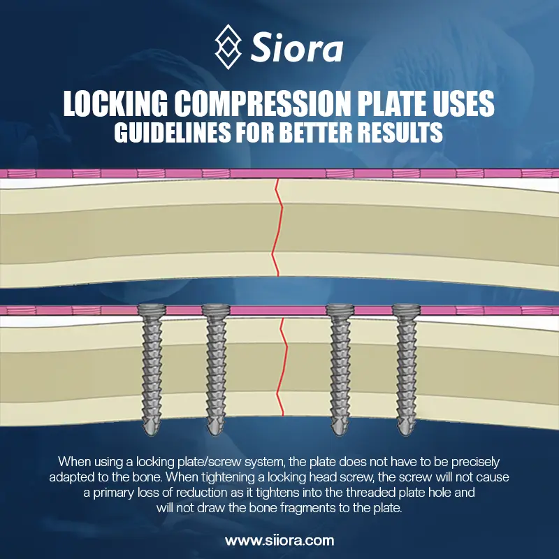 Locking Compression Plate Uses
