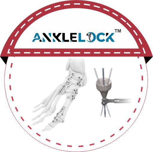 ANKLELOCK malaysia