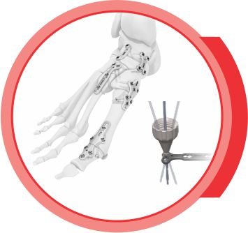 ANKLELOCK
