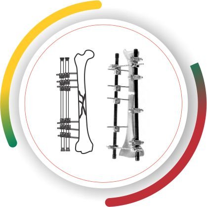 EXTERNAL FIXATOR Lithuania