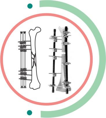 EXTERNAL FIXATOR dubai