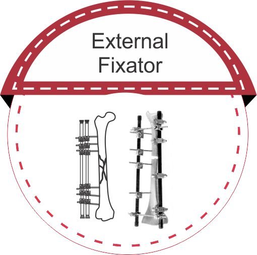 EXTERNAL FIXATOR malaysia