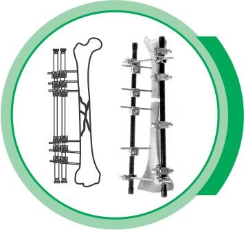 EXTERNAL FIXATOR niger