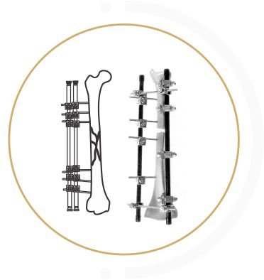 EXTERNAL FIXATOR thailand