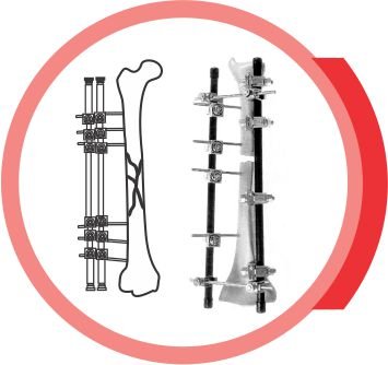 EXTERNAL FIXATOR