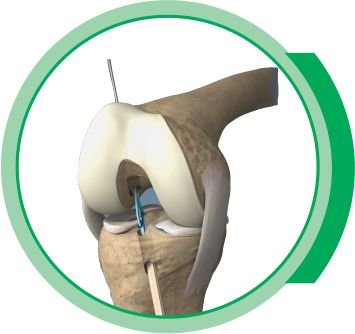 KNEE & SHOULDER niger