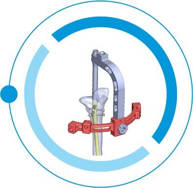 SUPRAPATELLAR tanzania