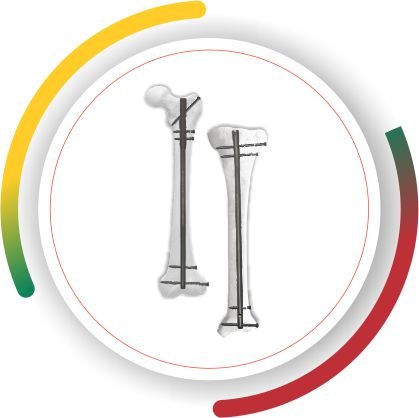 TIBIA FEMUR Lithuania