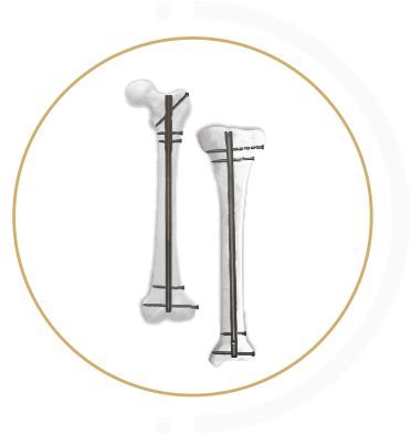 TIBIA FEMUR thailand