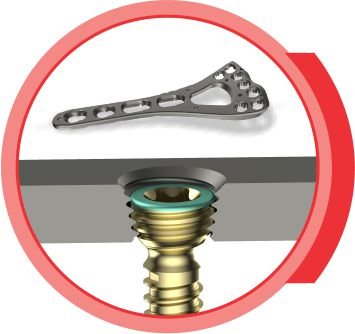 VARIOLOCK