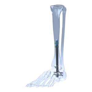 Tarsofix Ankle Nailing System