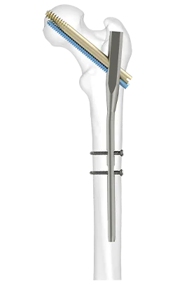 intamadullary nail