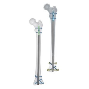 Rigifix™ Multilock Retrograde Femoral Nail