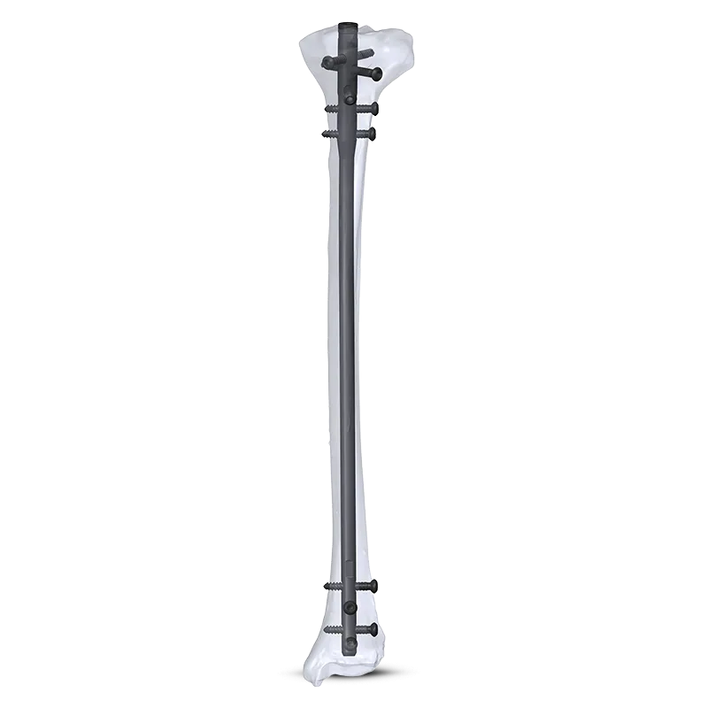 Aduera™ Expert Tibia Nail with bone