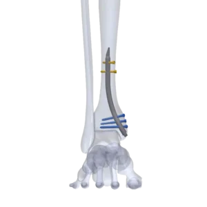 DISTLON™ Distal Tibia Nail