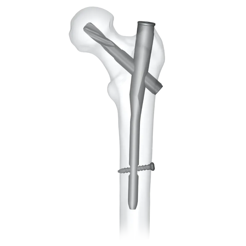 PFNA Nailing System