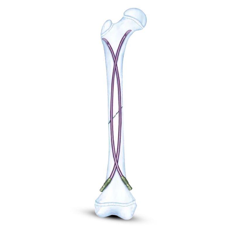 Titanium Elastic Nailing System