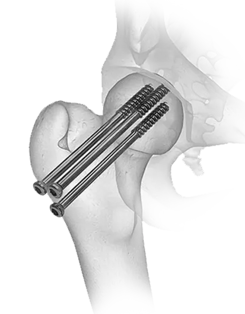 cannulated screw