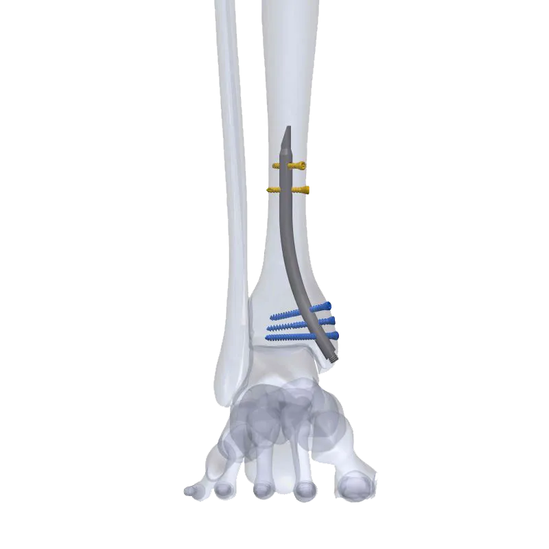 DISTLON™ Distal Tibia Nail