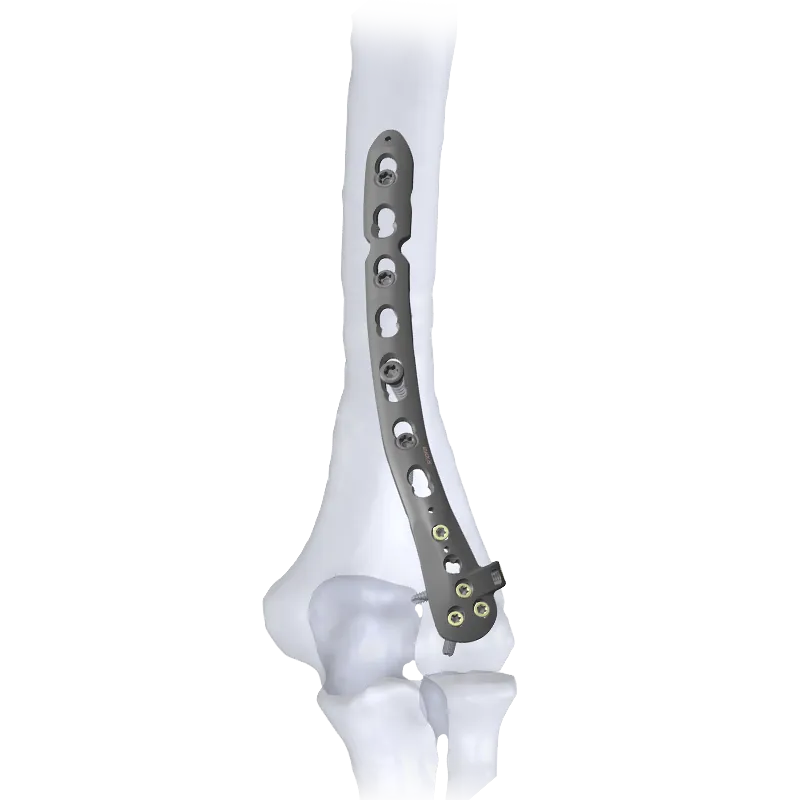 Locking Distal Humerus Plate with bone